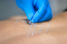 dry needling stock photo