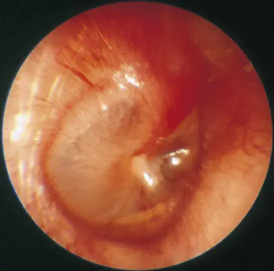 Blocked Ear After a Cold: What ENT Doctors Actually See