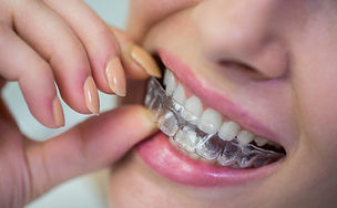 Invisible Braces in Himayatnagar