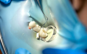 Composite Resin and Mercury-Free Dental Fillings.jpg