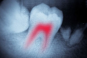 Root canal rate biodent