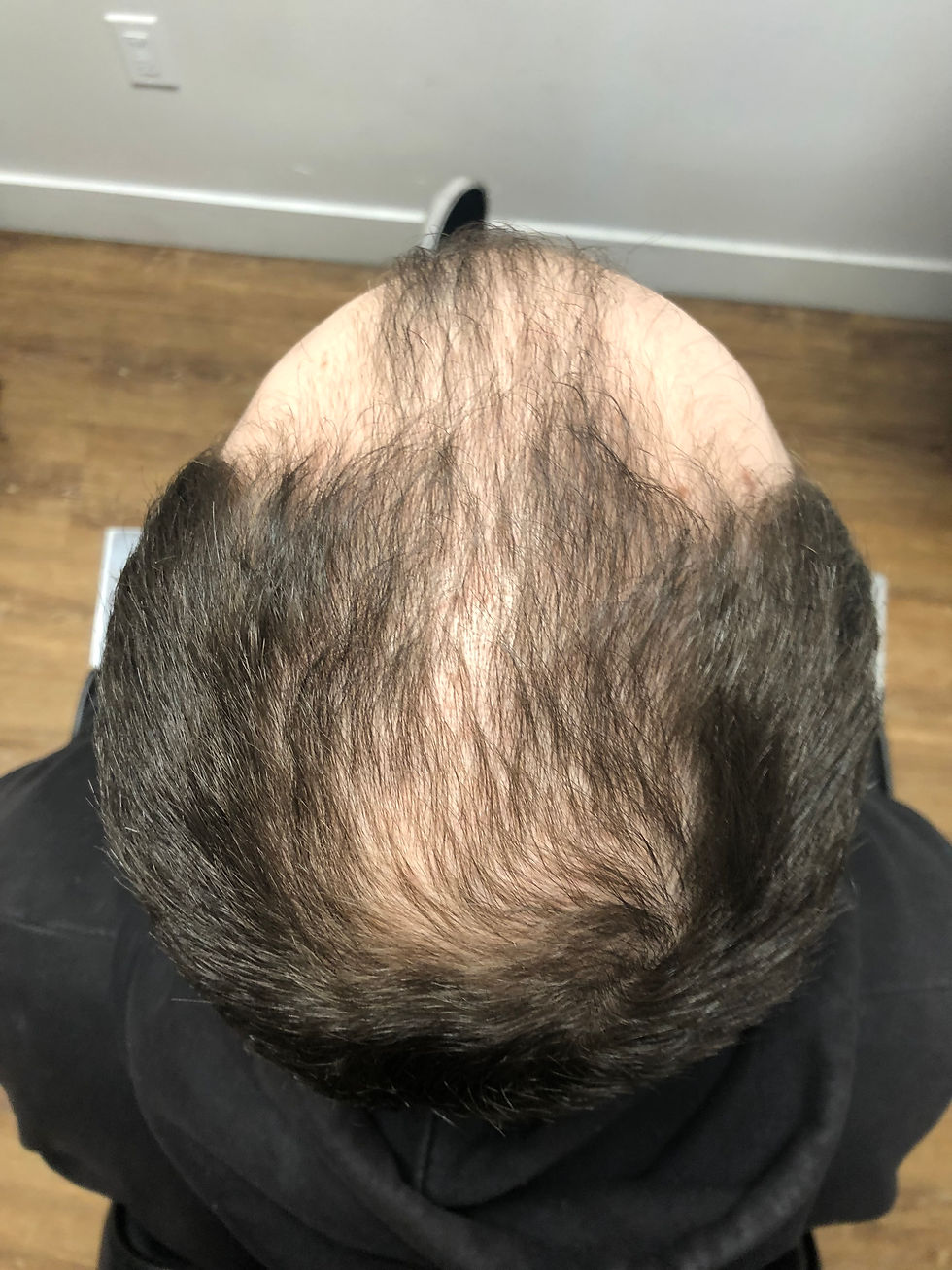 Top-down view of a man's head showing thinning hair on the crown