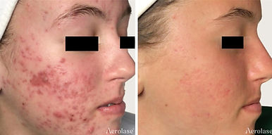 skinboss-eyescovered-acne-before-and-after (2).jpg