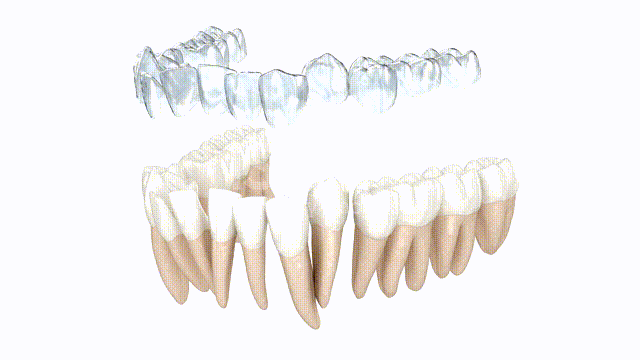 Invisalign Video