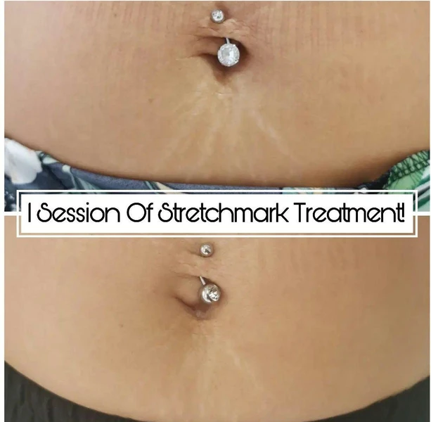 Stretch mark repair microneedling course