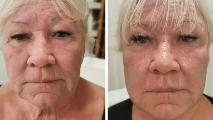 Anti Aging Microneedling Masterclass