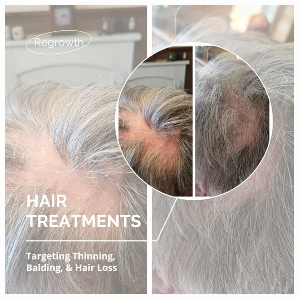 Hair Loss Microneedling Masterclass