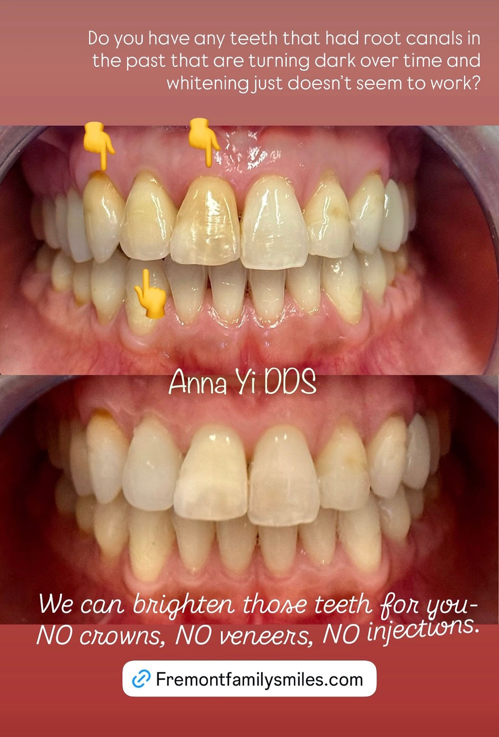 Brighten Darkened Teeth After Root Canals Without Crowns or Veneers