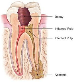 Infected-tooth-270x300.jpg