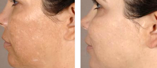 Microneedling Before & After Sun Damage