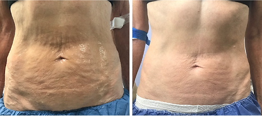 MicroNeedling Abdomen.png