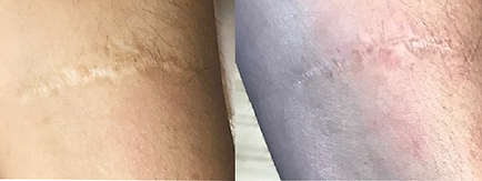 Microneedling BodyLab 7.png