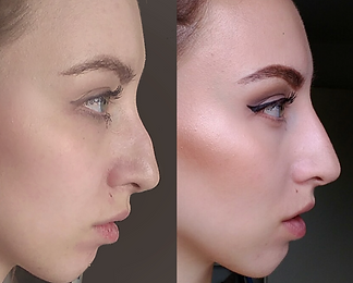 Nonsurgical Nose Job