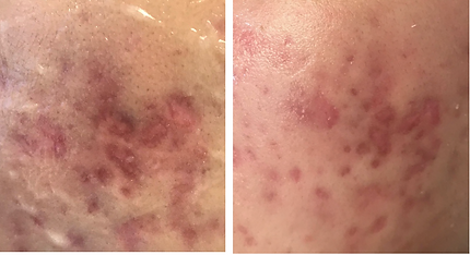 Microneedling Before & After Acne Scar
