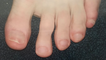 PinPointe Toe Fungus After Laser Removal