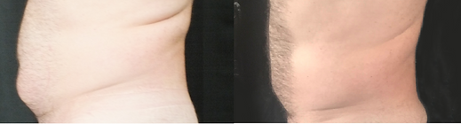 CoolSculpting Results BodyLab 5.png