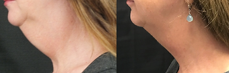 CoolSculpting Results BodyLab 3.png