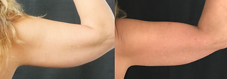 CoolSculpting Results BodyLab 4.png