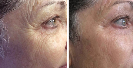 Microneedling Before & After Crows Feet