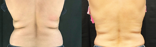 CoolSculpting Results BodyLab 2.png
