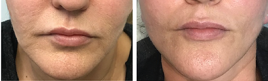 MicroNeedling_Face.png