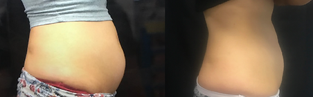 CoolSculpting Results BodyLab 1.png