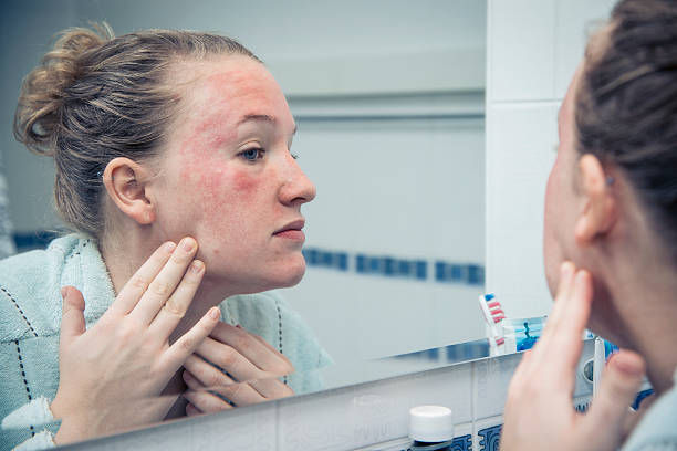Thumbnail: Eczema Relief Oil