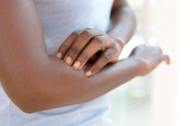 Thumbnail: Eczema Relief Oil
