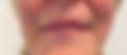 Patient fine lines around lips after filler