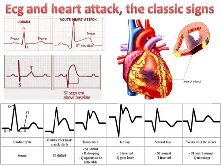 Ecg in casa