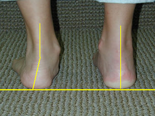 Foot with a collapsing arch showing the ankle rolling inward and the inner foot dropping toward the ground.
