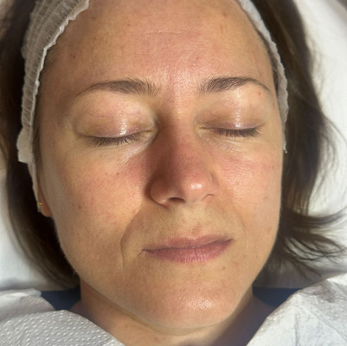 Inainte de procedura Oxygenera Pro - Anca Cosmetics Studio