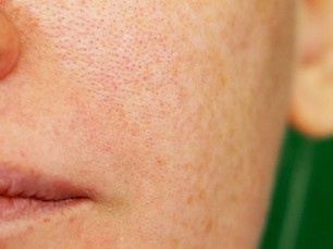 Anti-pigmentare: Cum se formează petele și ce tratamente chiar dau rezultate