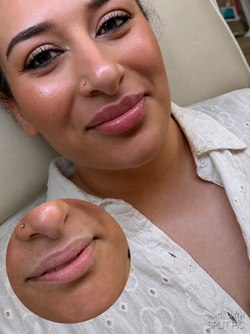 Lip Enhancement