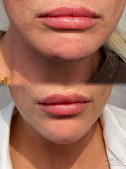 Lower Face Tox