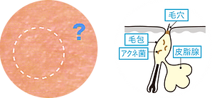 マイクロコメド(微小面ぽう).png