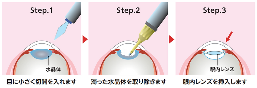 越谷駅前眼科 白内障手術