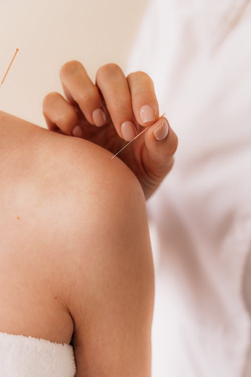 Woman receiving acupuncture treatment