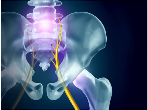 Image of x-ray into sciatica patient