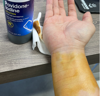Image shows a hand and forearm, facing up, with the wrist area covered in Betadine - showing yellow-orange coloration
