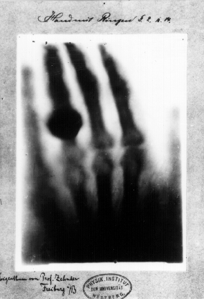 Photo showing a print of Wilhelm Röntgen’s first “medical” X-ray, of his wife’s hand, taken on 22 December 1895