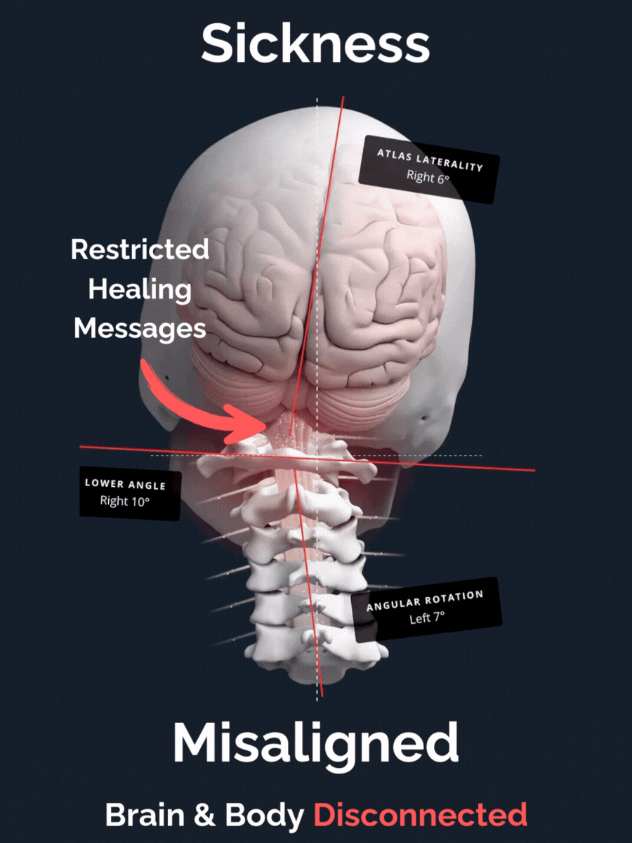 Elite upper cervical misaligned Atlas.gif