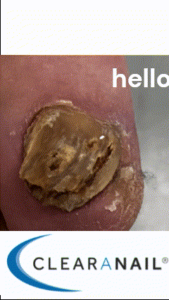 Fungal Nail Clearanail Treatment Fungal Face Goodbye.gif