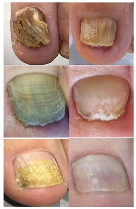 clearanail report - patient X close up jpg.jpg