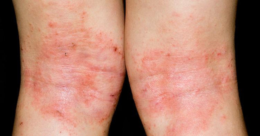 benh-cham-eczema3.jpeg