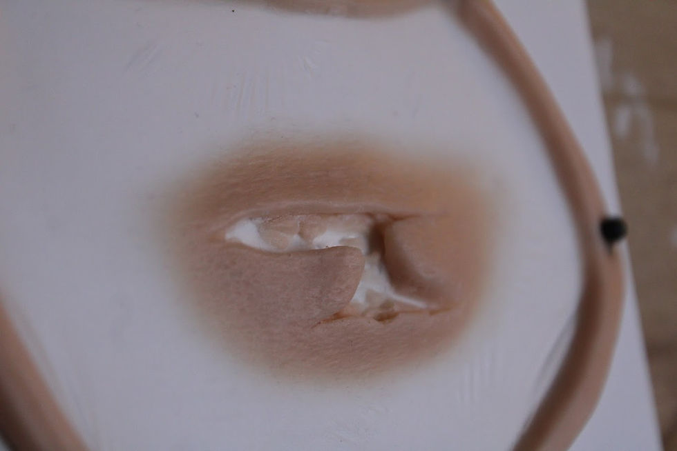 Thumbnail: deep wound injury 2 prosthetic