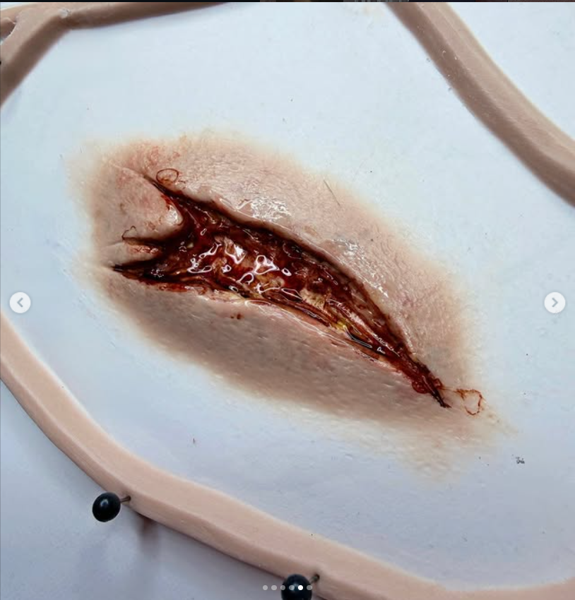 Thumbnail: The Injury Kit Silicone Prosthetic