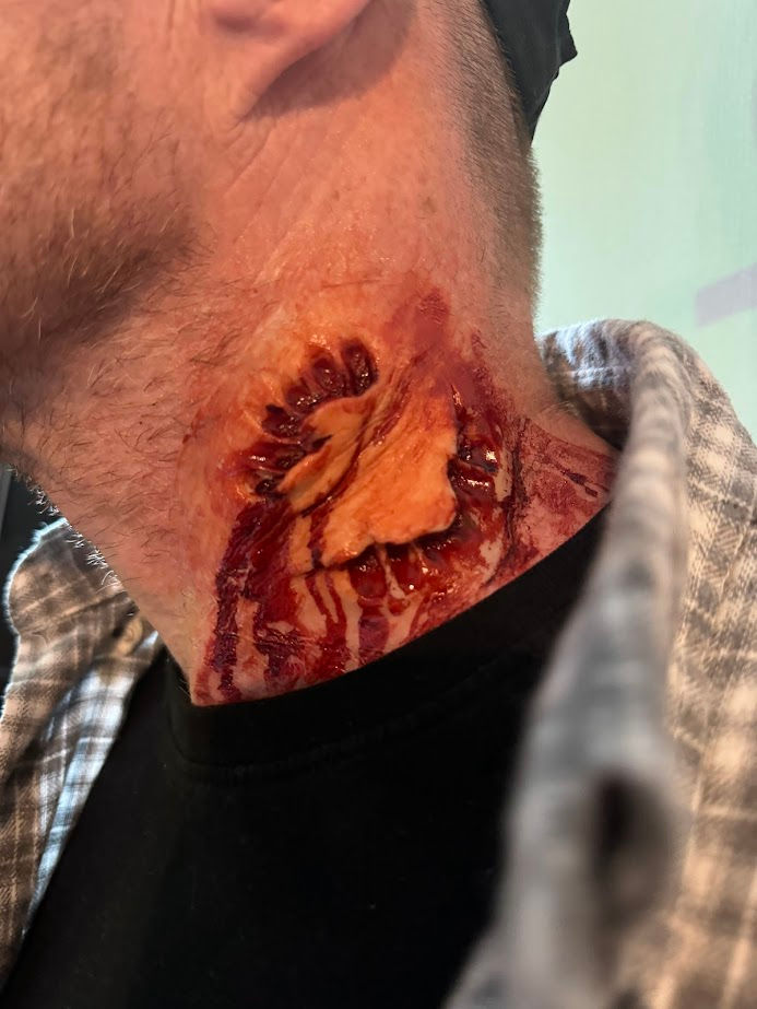 Thumbnail: Vampire bite #1 - Silicone Prosthetic