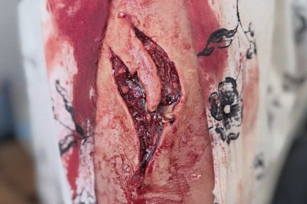 Thumbnail: injury #1 prosthetic