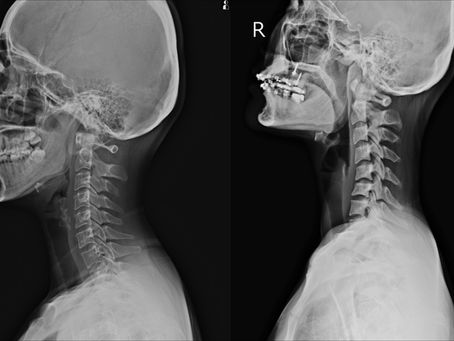The Important Role of the Cervical Curve